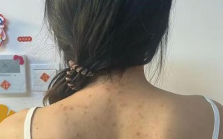 除螨方法（被螨虫折磨了一年多才知道这个方法的我后悔死了）