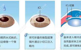 近视手术大概多少费用？广州近视手术价格一览表2023